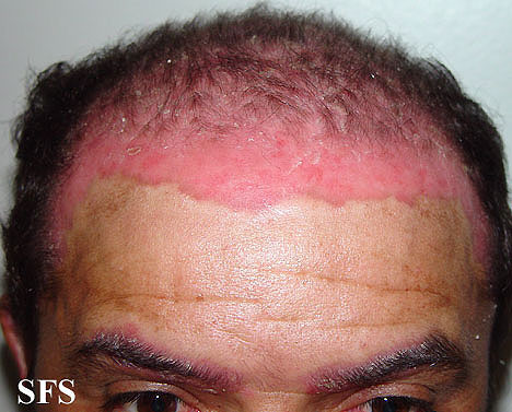 File:Psoriasis (Dermatology Atlas 25).jpg
