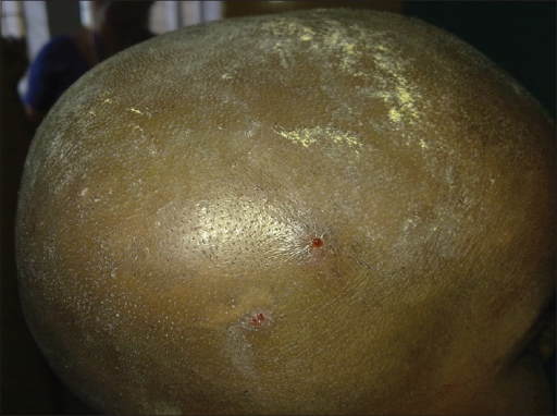 File:Sandalwood paste applied over scalp folliculitis.png