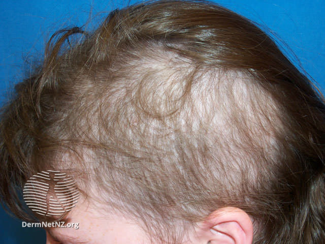 File:Trichotillomania (DermNet NZ doctors-follicular-images-hairloss10).jpg