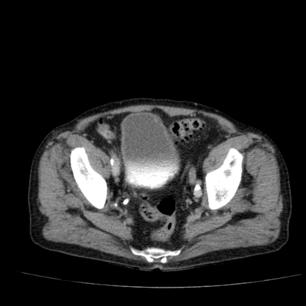 Abdominal aortic aneurysm (Radiopaedia 29248-29660 Axial C+ portal venous phase 53).jpg