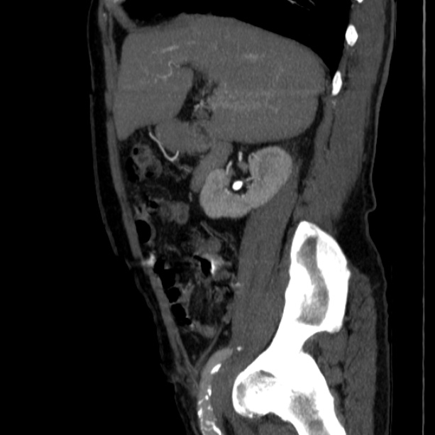 Abdominal aortic aneurysm (Radiopaedia 29248-29660 Sagittal C+ arterial phase 16).jpg