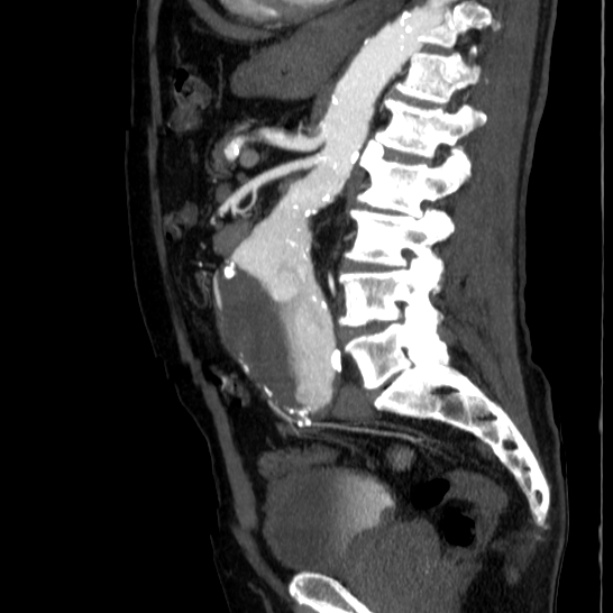 Abdominal aortic aneurysm (Radiopaedia 29248-29660 Sagittal C+ arterial phase 31).jpg
