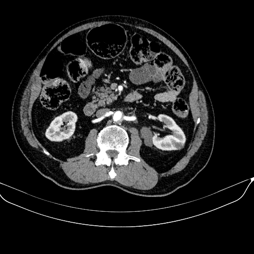 Abdominal aortic aneurysm (Radiopaedia 67117-76452 Axial C+ arterial phase 62).jpg