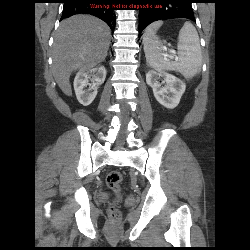 Abdominal aortic aneurysm (Radiopaedia 8190-9038 Coronal C+ arterial phase 91).jpg