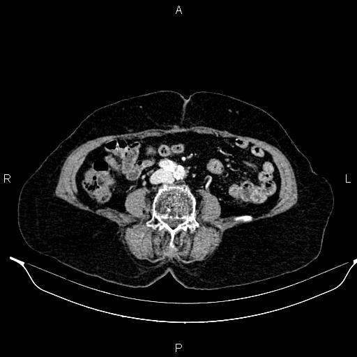 File:Abdominal aortic aneurysm (Radiopaedia 85063-100606 Axial C+ portal venous phase 47).jpg