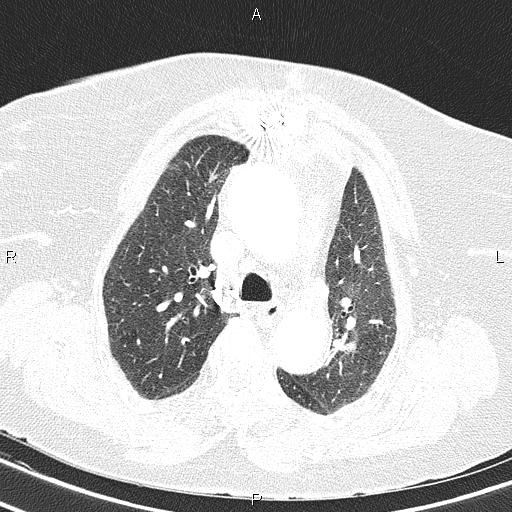 Abdominal aortic aneurysm (Radiopaedia 85063-100606 Axial lung window 25).jpg