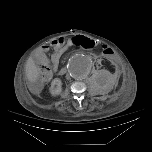 Abdominal aortic aneurysm - impending rupture (Radiopaedia 19233-19247 Axial non-contrast 90).jpg