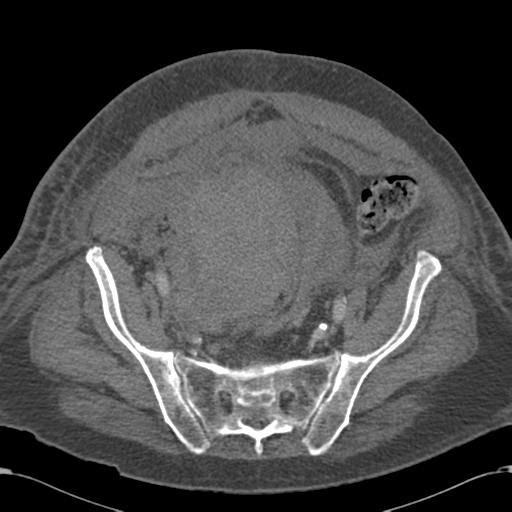 Abdominal hematoma (Radiopaedia 33614-34715 Axial C+ portal venous phase 100).png