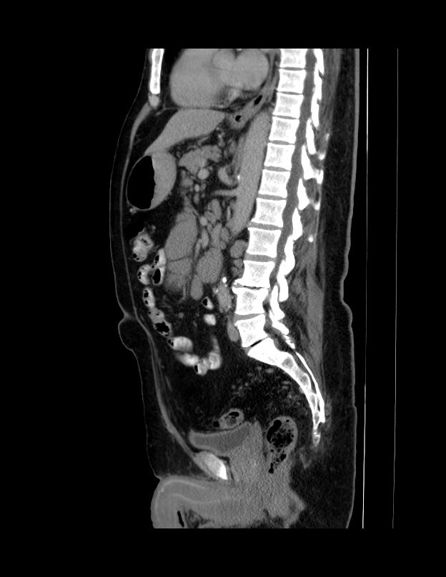Abdominal lymphoma - with sandwich sign (Radiopaedia 53486-59492 Sagittal C+ portal venous phase 37).jpg