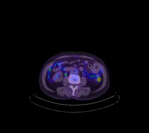 Abdominal wall metastasis from colorectal carcinoma (Radiopaedia 31016-31719 Axial 60).jpg
