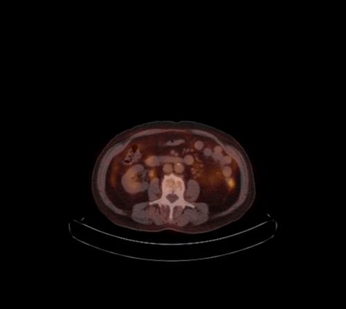 Abdominal wall metastasis from colorectal carcinoma (Radiopaedia 31016-31719 C 62).jpg