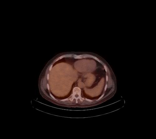 Abdominal wall metastasis from colorectal carcinoma (Radiopaedia 31016-31719 C 93).jpg