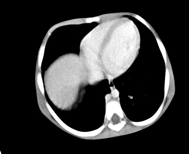 Abdominopelvic rhabdomyosarcoma (Radiopaedia 78356-90984 Axial C+ portal venous phase 33).jpg