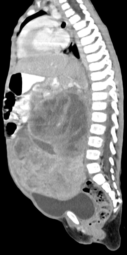 Abdominopelvic rhabdomyosarcoma (Radiopaedia 78356-90984 Sagittal C+ portal venous phase 46).jpg