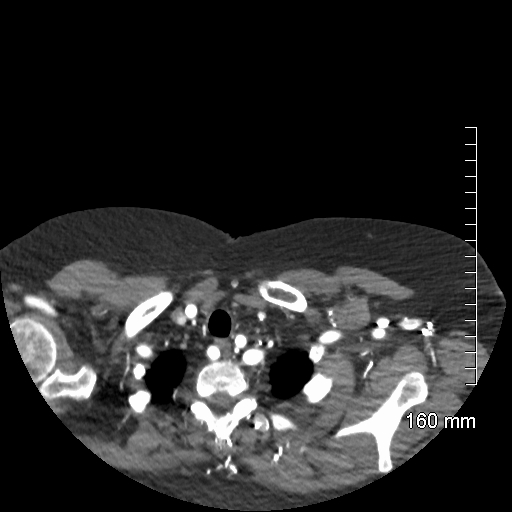 Aberrant right subclavian artery stenosis (Radiopaedia 52656-58670 Axial C+ arterial phase 8).jpg