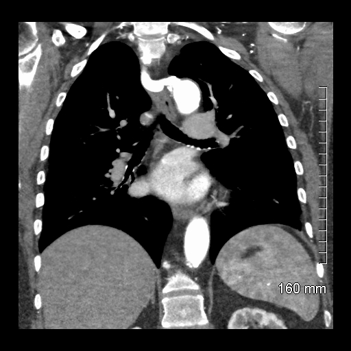 File:Aberrant right subclavian artery stenosis (Radiopaedia 52656-58670 B 54).jpg