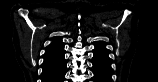 File:Accesory rib joint (Radiopaedia 71987-82452 Coronal bone window 72).jpg