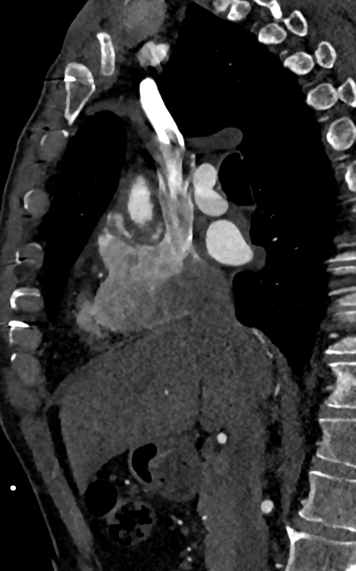 Accessory left atrial appendage (Radiopaedia 81987-95968 Sagittal C+ arterial phase 14).jpg