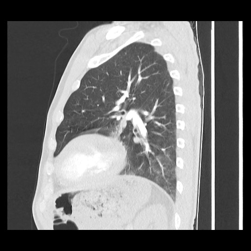 Accessory left horizontal fissure with lingular pneumonia (Radiopaedia 53763-59843 Sagittal lung window 48).jpg