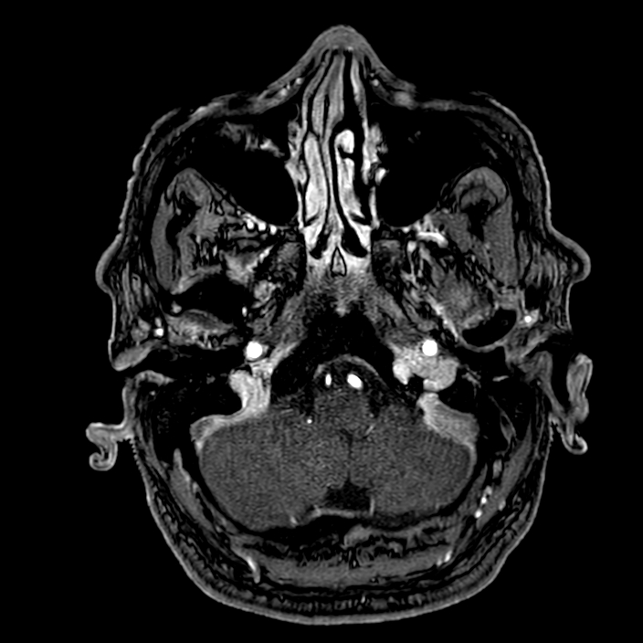 Accessory middle cerebral artery (Radiopaedia 73114-83828 Axial MRA 15).jpg