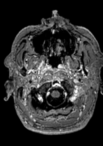 Accessory middle cerebral artery (Radiopaedia 73114-83828 Axial T1 C+ 190).jpg
