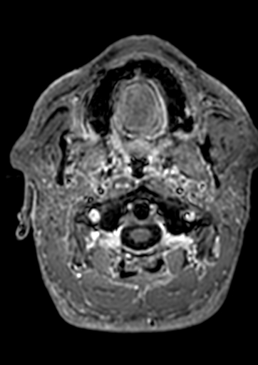Accessory middle cerebral artery (Radiopaedia 73114-83828 Axial T1 C+ 213).jpg
