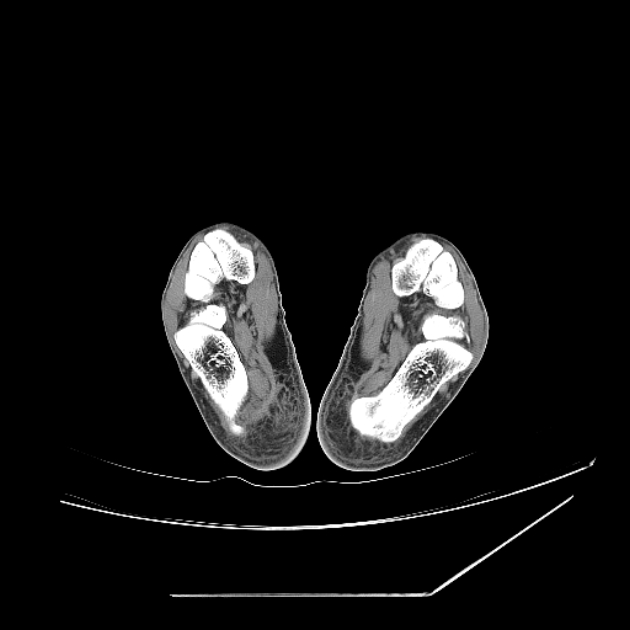 Accessory soleus muscle (Radiopaedia 61069-68943 Axial non-contrast 70).jpg