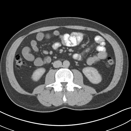 Achalasia of the cardia (Radiopaedia 38497-40595 Axial C+ portal venous phase 44).png