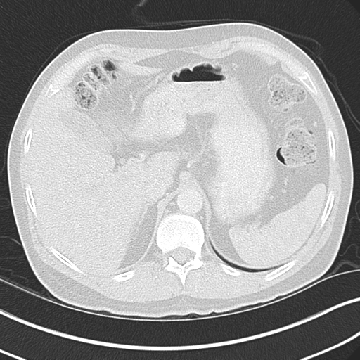 Achalasia of the cardia (Radiopaedia 38497-40595 Axial lung window 51).png