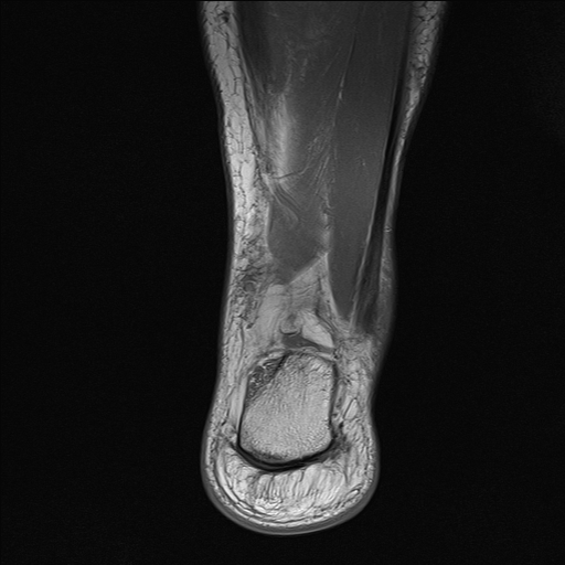 File:Achilles tendon tear (Radiopaedia 77615-89819 Coronal T1 23).jpg