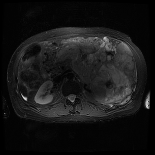 Acinar cell carcinoma of the pancreas (Radiopaedia 75442-86668 Axial T2 fat sat 37).jpg