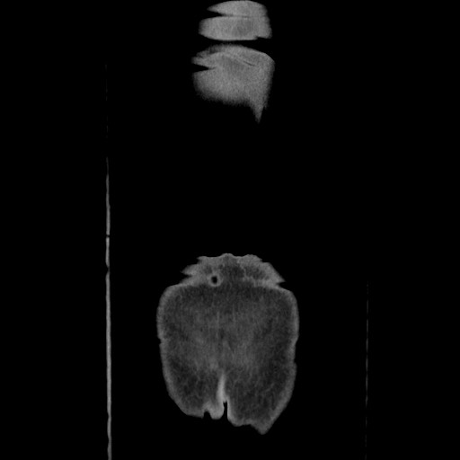 Acinar cell carcinoma of the pancreas (Radiopaedia 75442-86669 Coronal C+ portal venous phase 126).jpg
