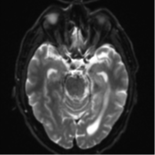 File:Acoustic schwannoma (Radiopaedia 55729-62281 E 9).png