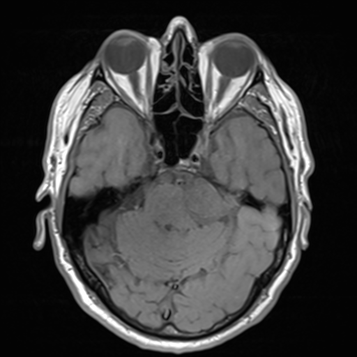 File:Acoustic schwannoma (Radiopaedia 55729-62281 T1 10).png
