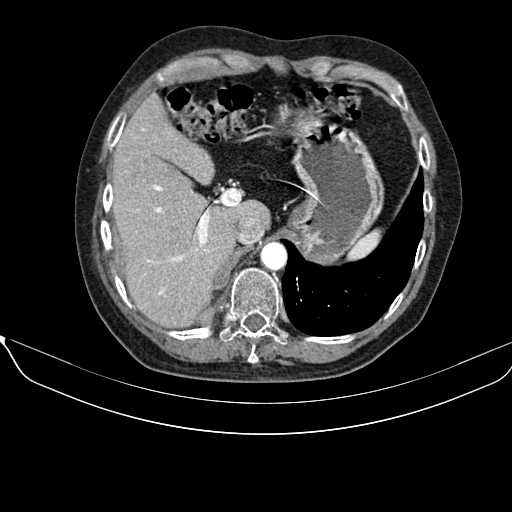 File:Acquired adrenal hyperplasia - due to thymic carcinoid tumor (Radiopaedia 21269-21184 C+ arterial phase 16).jpg