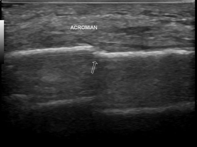 File:Acromial fracture - ultrasound (Radiopaedia 26729-26891 Longitudinal 1).jpg
