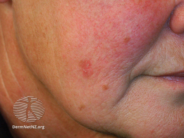 Actinic Keratoses affecting the face (DermNet NZ lesions-ak-face-276).jpg