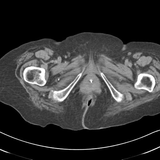 Active bleeding from duodenal ulcer with embolization (Radiopaedia 34216-35481 Axial non-contrast 75).png