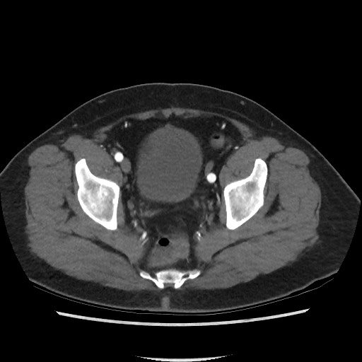 Active colonic bleed on CT (Radiopaedia 49765-55025 Axial C+ arterial phase 73).jpg