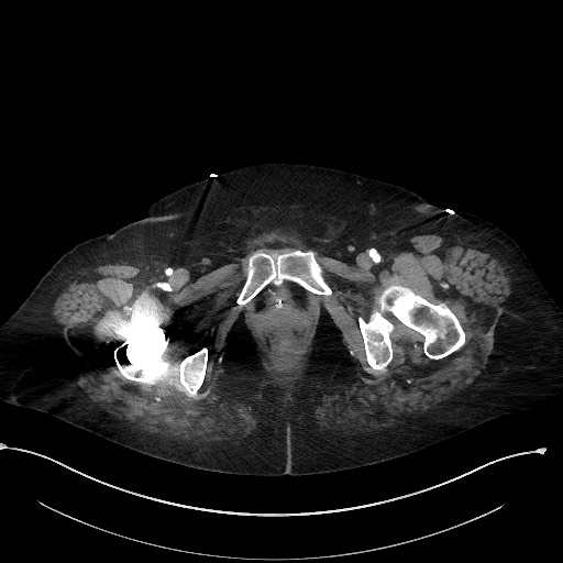 Active renal extravasation with large subcapsular and retroperitoneal hemorrhage (Radiopaedia 60975-68796 Axial C+ arterial phase 198).jpg