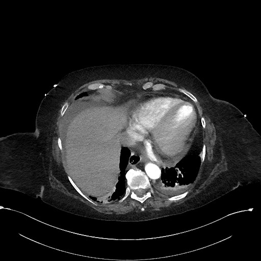File:Active renal extravasation with large subcapsular and retroperitoneal hemorrhage (Radiopaedia 60975-68796 Axial C+ arterial phase 25).jpg