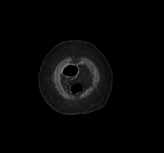 Active renal extravasation with large subcapsular and retroperitoneal hemorrhage (Radiopaedia 60975-68796 Coronal C+ portal venous phase 15).jpg
