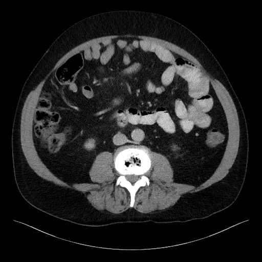 Acute-on-chronic pancreatitis (Radiopaedia 67286-76656 Axial C+ portal venous phase 43).jpg