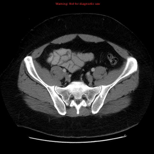 File:Acute appendicitis (Radiopaedia 12326-12607 Axial C+ portal venous phase 40).jpg