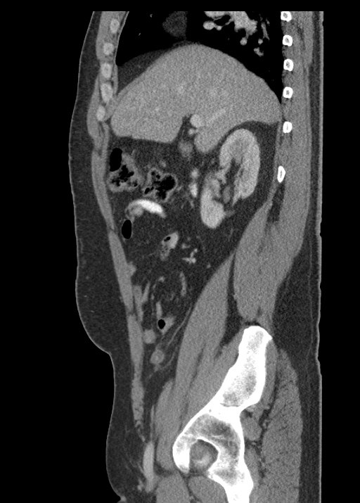 Acute appendicitis (Radiopaedia 48511-53463 Sagittal C+ portal venous phase 51).jpg