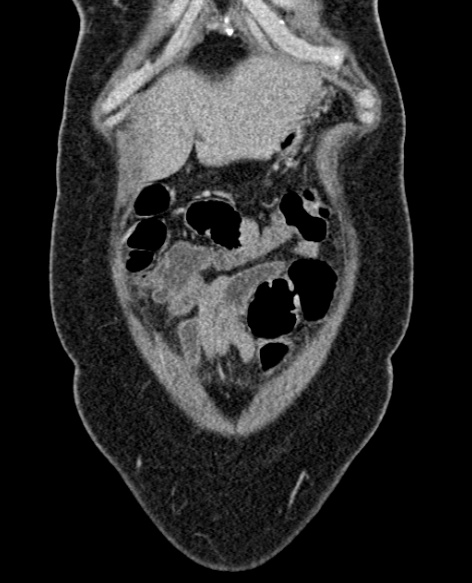 File:Acute appendicitis (Radiopaedia 48792-53822 Coronal C+ portal venous phase 45).jpg