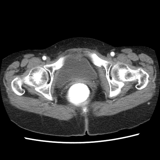 File:Acute appendicitis (Radiopaedia 52672-58589 Axial C+ arterial phase 35).jpg