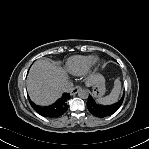 Acute appendicitis (Radiopaedia 58627-65818 Axial non-contrast 11).jpg