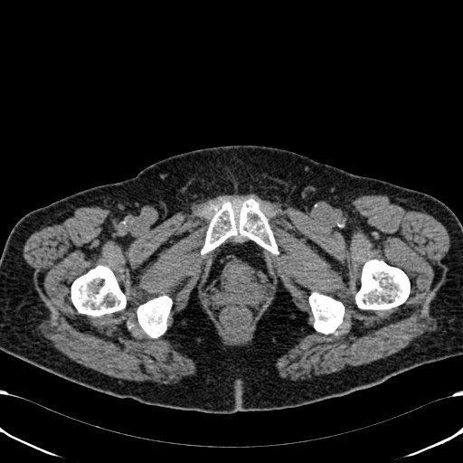 Acute appendicitis (Radiopaedia 58627-65818 Axial non-contrast 90).jpg