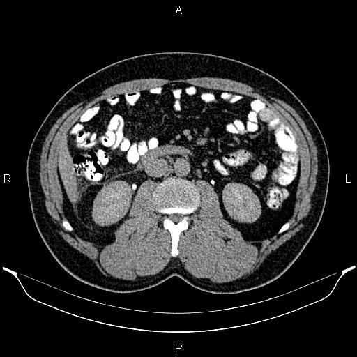 Acute appendicitis (Radiopaedia 84780-100240 Axial C+ delayed 48).jpg